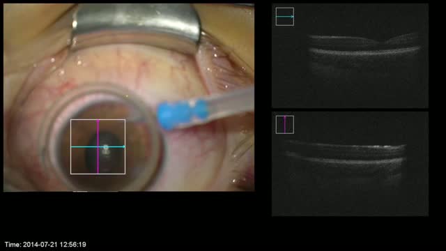 Removal of Anterior Blood Clot in a Pediatric Patient