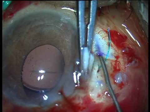 Glued IOL Live Surgery