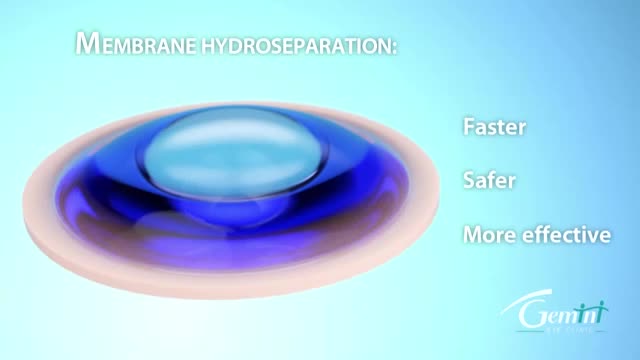 Hydroseparation: A new way to perform DMEK