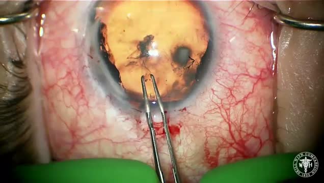 Traumatic Cataract and Aniridia 