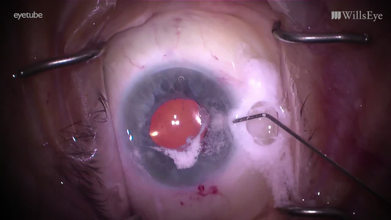 Cataract Surgery in the Setting of Pseudoexfoliation