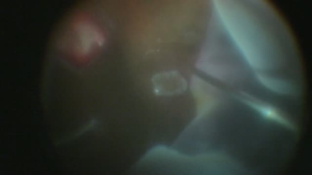23-25 Gauge Autologous Choroid RPE Transplantation