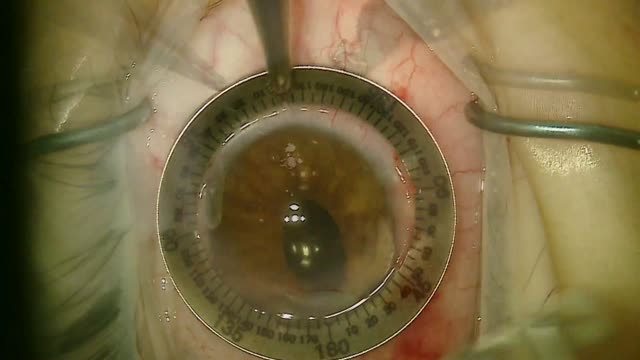 Gore-Tex IOL With Limbal Relaxing Incision