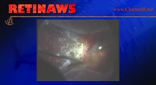 Retinal Detachment & Attached Vitreous