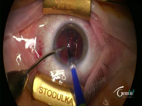 Laser-assisted Cataract Surgery (VICTUS Laser) with Incise IOL Implantation