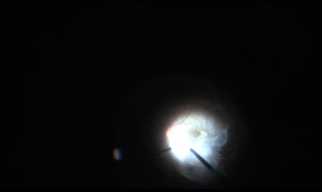 Hyperosmotic Macula