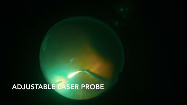 27-Gauge Vitrectomy for Retinal Detachment