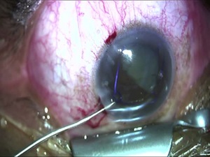 Placement of a Malyugin Ring