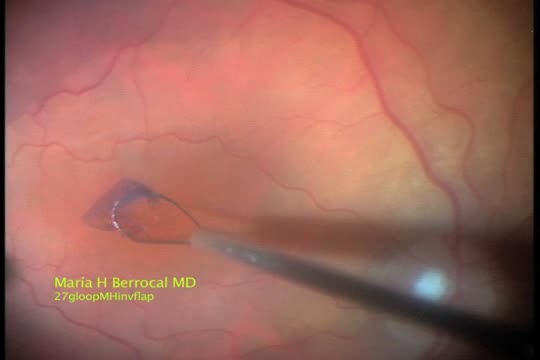 Inverted Flap Technique for Large Macular Hole Repair