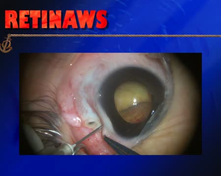 Coats Disease