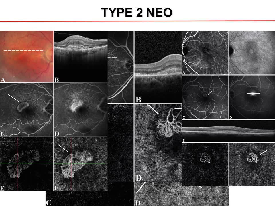 OCT-A: Type 2 Neovascularization