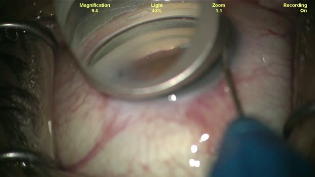 Surgical Case With Hydrus