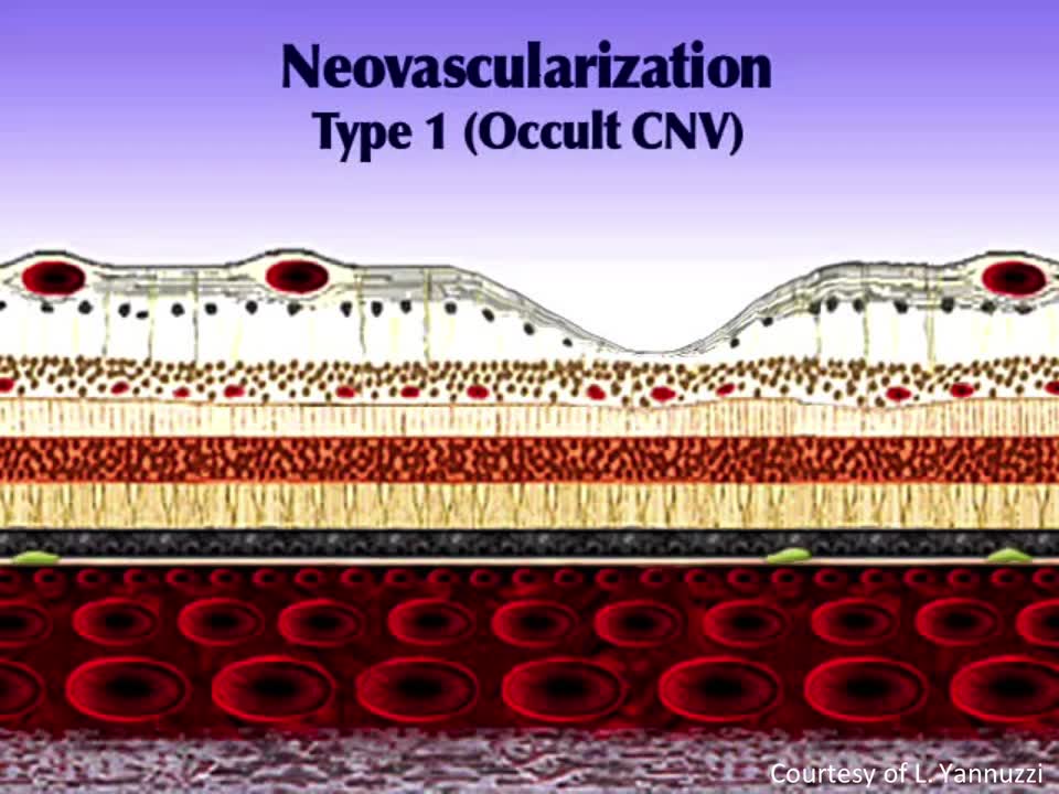  Using ZEISS Angioplex&reg; Segmentation to Visualize CNV in Type 1 AMD