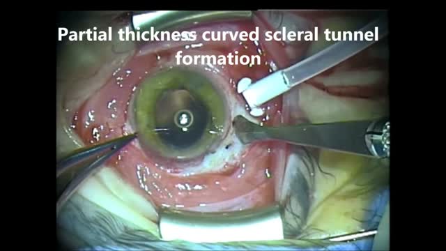 The Evolution of IOL Fixation Part I: Large Incision 
