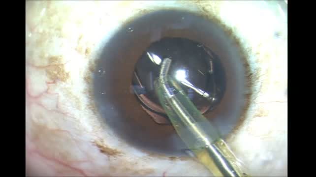 Viscoelastic Insertion and Removal 