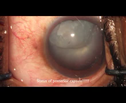 Phaco in Traumatic Cataract with Anterior and Posterior Capsule Rupture