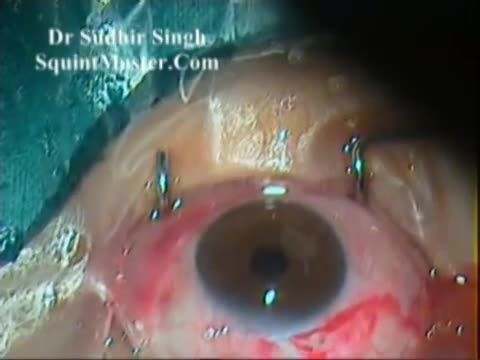 MSICS In Floppy Iris and Non-dilating Pupil
