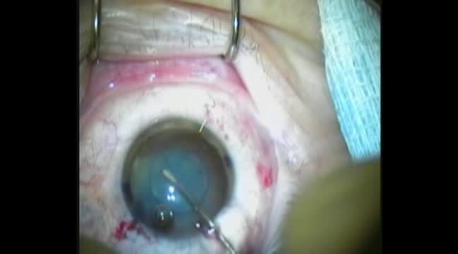 Femtosecond Cataract in Open PC
