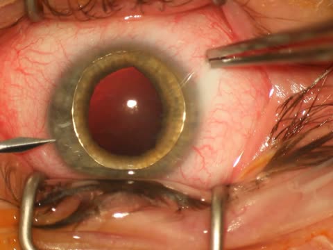 Crystalline Lens Luxation to the Anterior Chamber 