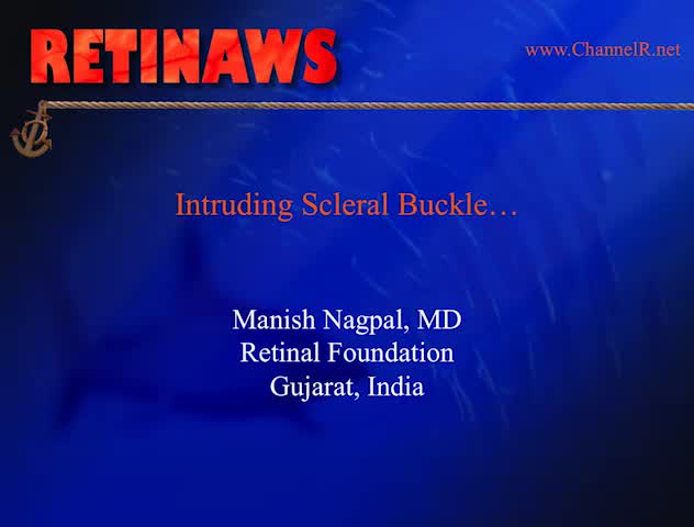 Introducing Scleral Buckle