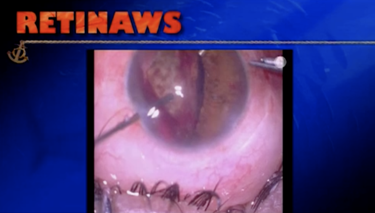 Intruded Scleral Buckle