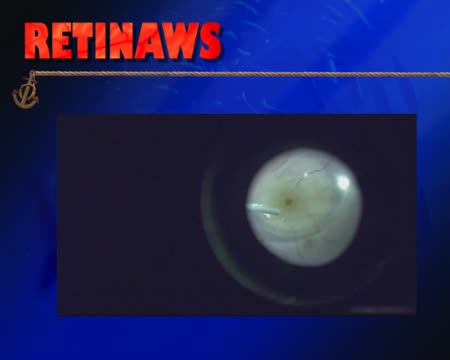 Macular Hole & Perfluoron 