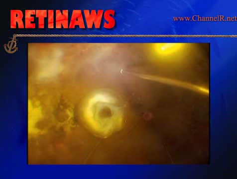 Thumbnail for othod