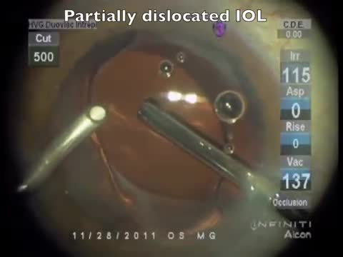 Optic Capture to Re-Center a Tilted IOL