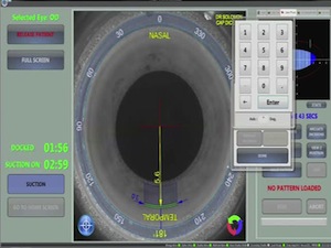 Femtosecond Arcuate Incisions: From Start to Finish