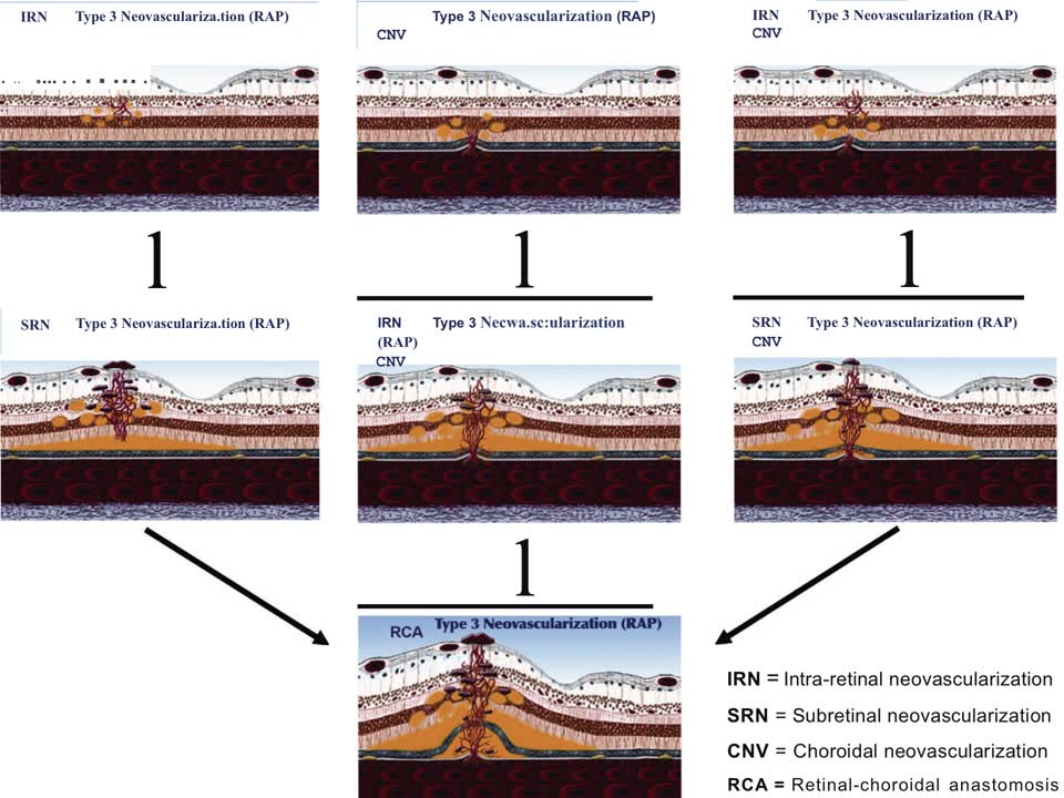 OCT-A: Understanding Type 3 Neovascularization