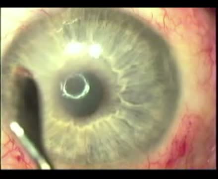 Corneal Scars: A Refractive Surgery