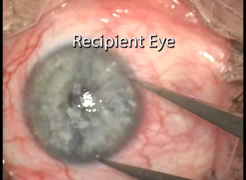 CLAU (Conjunctival Limbal Autograft) for Unilateral Limbal Stem Cell Deficiency