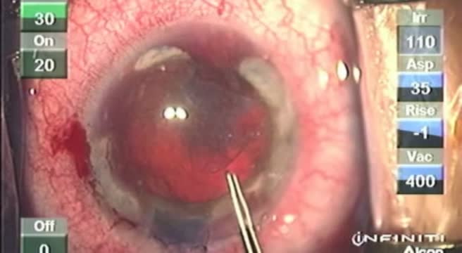 Morgagnian Cataract with Femtolaser Assisted Surgical Complication