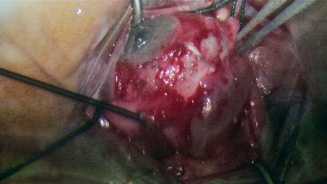 Temporary Keratoprosthesis in Two Cases