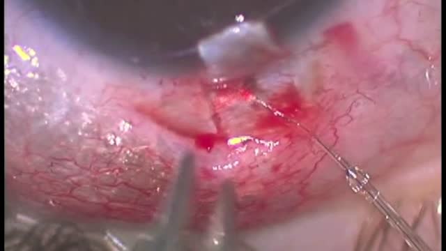 360 Degree Trabeculotomy utilizing the iScience Microcatheter in Pediatric Glaucoma