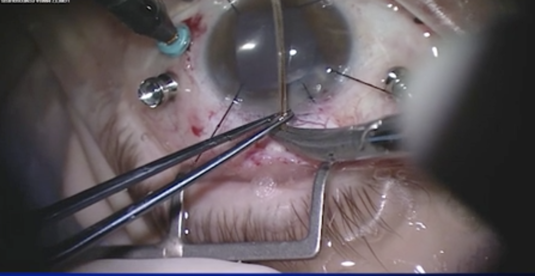 Supra-Choroidal Surgery