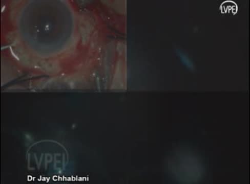 Subretinal Air: A Complication During Retinal Detachment Repair