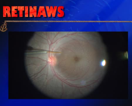 Macular Edema & Retinitis Pigmentosa