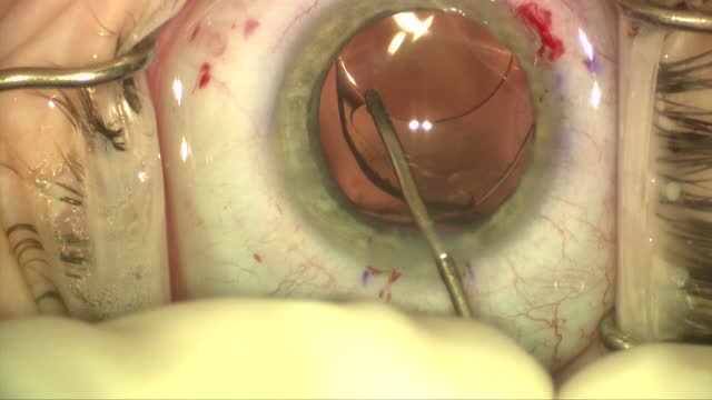 Catalys in Marfan's Syndrome Case