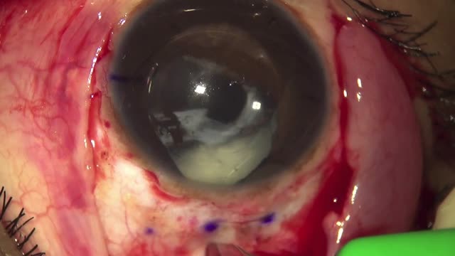 Refractive IOL Explant with L-Incision and Trocar ACM for Soemmering Ring Removal with Glued IOL and Pupilloplasty