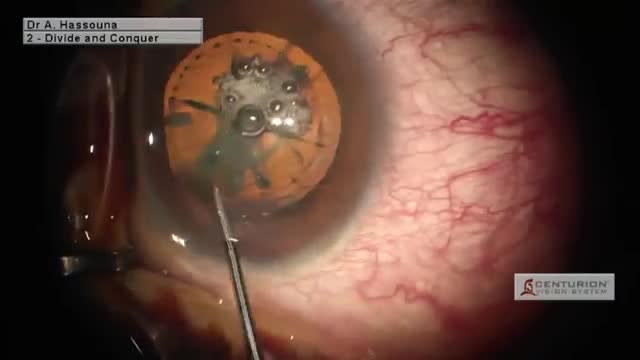Spatula For Opening Femtosecond Incisions