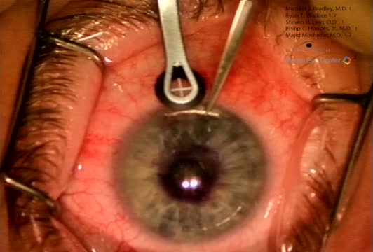 Simultaneous LASIK and KAMRA Inlay Surgeries