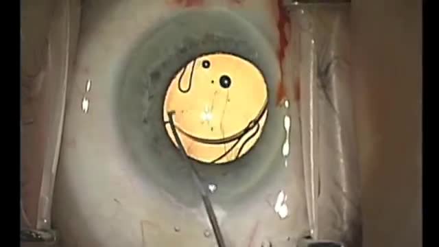 Rayner Sulcoflex Implantation