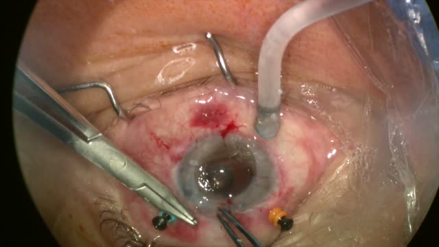 Temporary Keratoprosthesis in Vitreoretinal Surgery