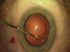 Combined Phacovitrectomy