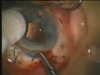 Intraocular Suturing 
