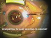 Removal of 5000 Centistokes Silicone Oil Using 25G Vitrectomy Technique