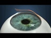 Effects of Femtosecond Flap Design on Dry Eye and Corneal Sensation