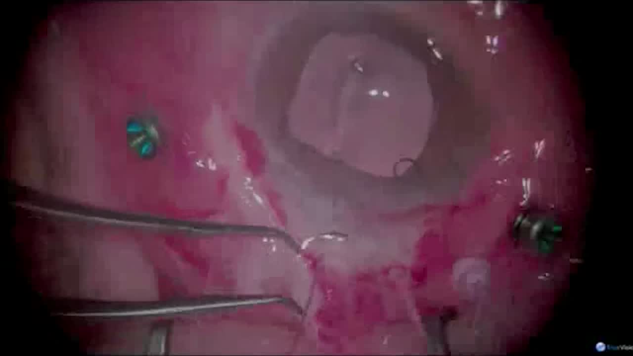 Endophthalmitis
