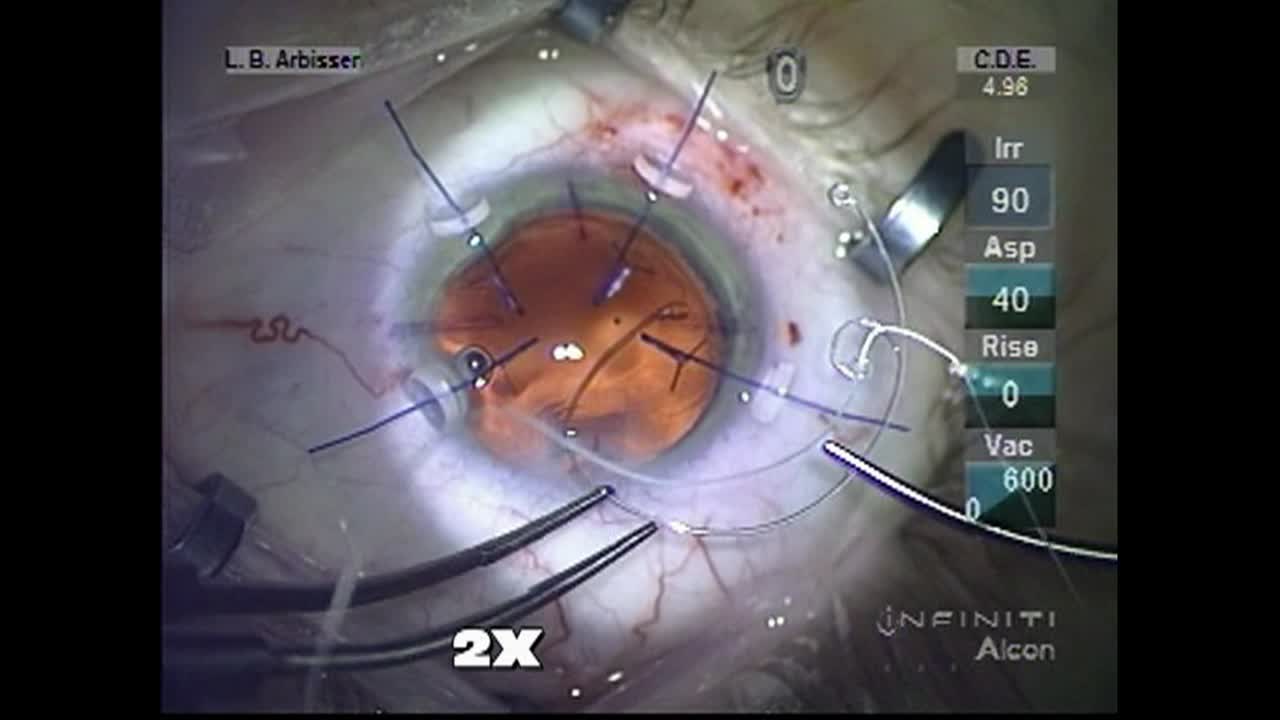 Be Prepared for Surprise Zonulopathy